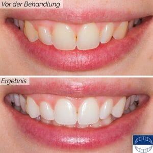 Bleaching before and after photo