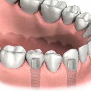 Brücke auf 2 Implantaten