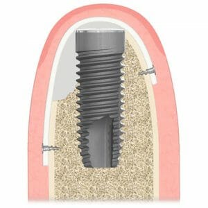 Knochenaufbau-Implantat-Neoss Implantat mit Knochenaufbau