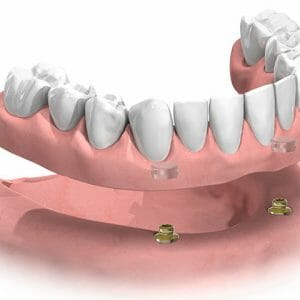 Prothese auf 2 Implantaten, abnehmbar