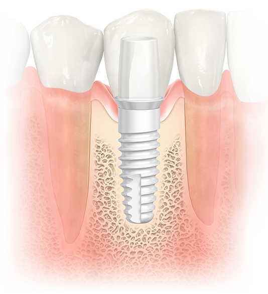 Keramikimplantat